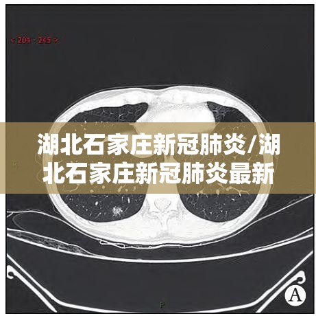 湖北石家庄新冠肺炎/湖北石家庄新冠肺炎最新消息